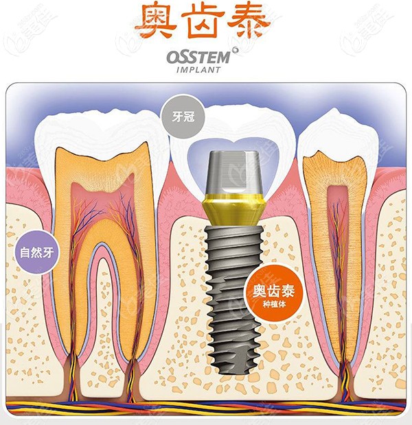韩国奥齿泰OSSTEM种植牙