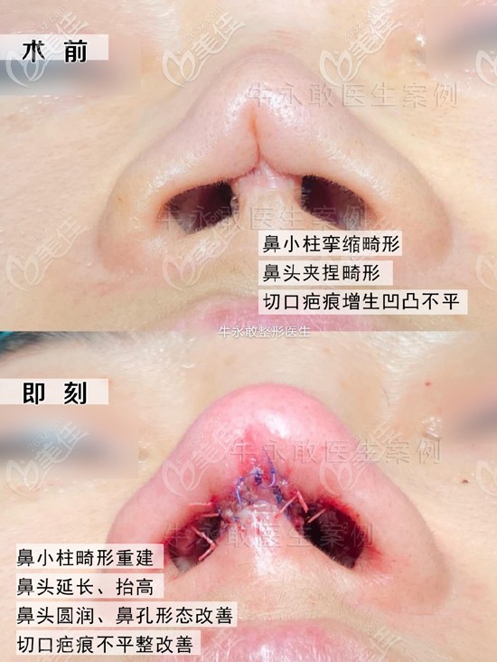 自体肋软骨修复鼻失败案例