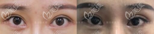 魏志香内眼角修复前后对比照