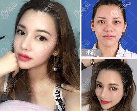 我找北京美莱董岩岩做的假体鼻综合案例效果 我找北京美莱董岩岩做的假体鼻综合案例效果