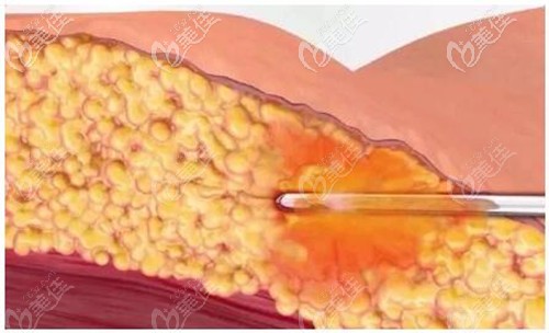 5g天使光雕吸脂过程 5g天使光雕吸脂过程
