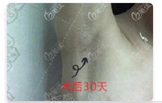 南京隆胸推荐沈正宇医师，我做的290CC韩国蓓拉假体，术后腋下疤痕几乎看不到