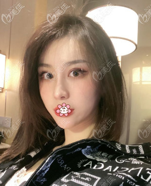 陈健医生给我做完肋骨鼻一个月 陈健医生给我做完肋骨鼻一个月