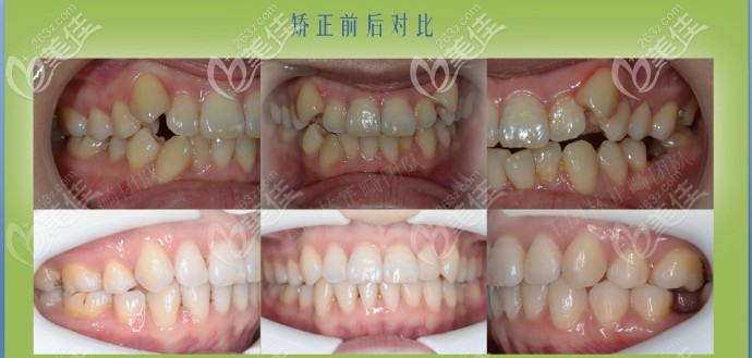 王国林隐形矫正案例