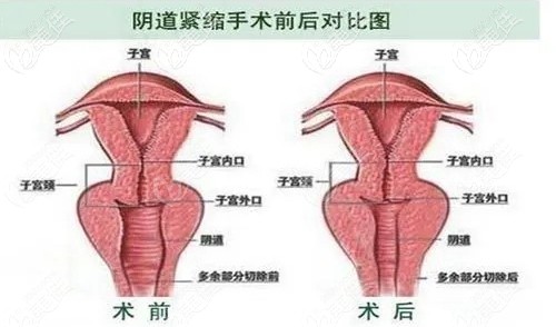 缩阴手术效果