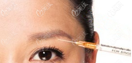 玻尿酸丰眉弓示意图