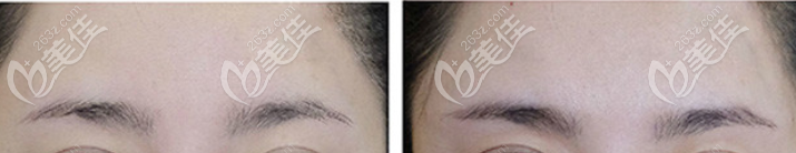 玻尿酸丰眉弓案例效果图