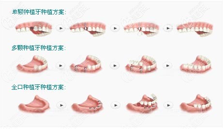 各种种植牙
