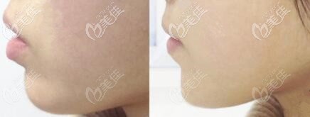 菲羽玻尿酸丰下巴真人前后对比照