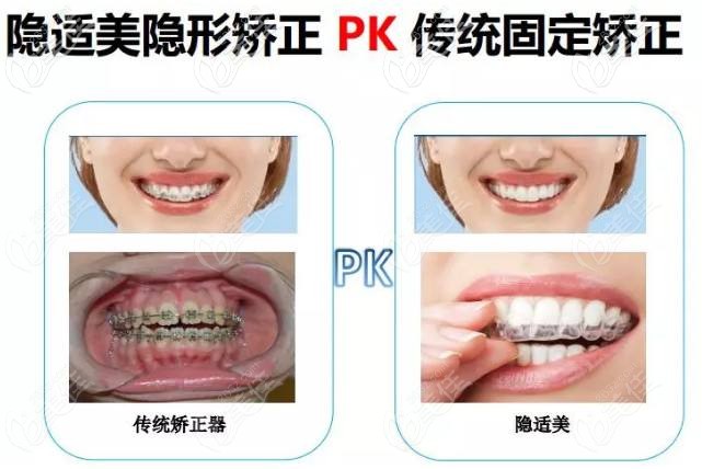 隐适美可以矫正30岁的龅牙问题