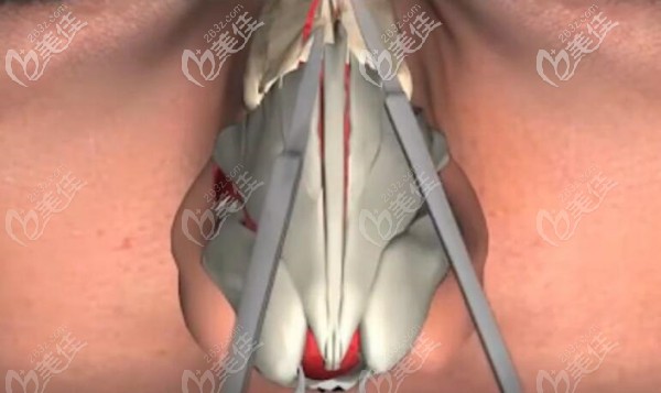 用骨凿将鼻背鼻骨和鼻外侧软骨过宽的部分截断
