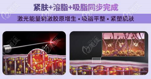 5g天使光雕集紧肤+溶脂+吸脂同步进行 5g天使光雕集紧肤+溶脂+吸脂同步进行