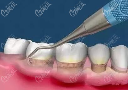 而有效的方式就是龈上洁治和龈下刮治,去除牙齿表面和牙周袋内的菌斑
