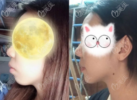 美立刻隐形矫正案例