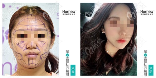 任学会全脸自体脂肪填充