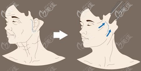 小切口拉皮位置