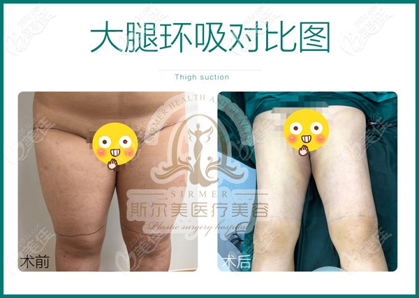 合肥斯尔美整形大腿环吸案例 合肥斯尔美整形大腿环吸案例