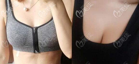 花苞提胸术效果前后对比
