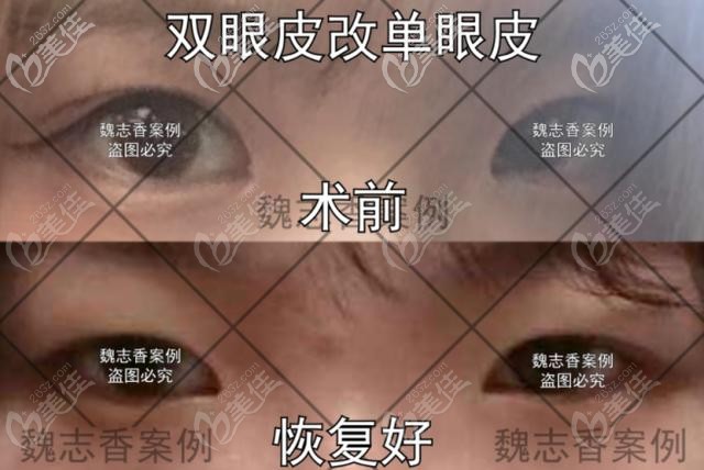 魏志香医生双眼皮改单眼皮对比实例
