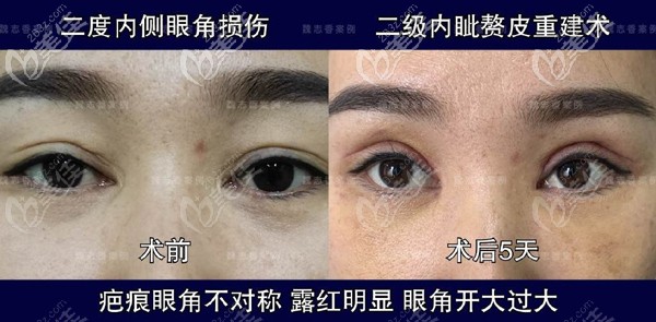 魏志香医生开眼角括号型疤痕修复对比