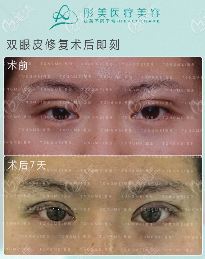 潘彦龙医生凹陷性疤痕修复术后7天的反馈