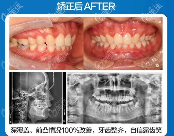 这是我在合肥贝杰口腔临泉路店矫正牙齿的日记:深覆盖+骨性前突哦
