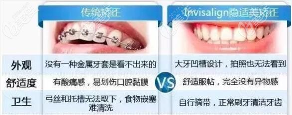 牙齿深覆合戴金属和隐形牙套哪个好