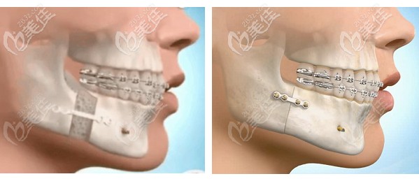 大家觉得广州广大医院何锦泉医生的正颌手术案例效果怎么样
