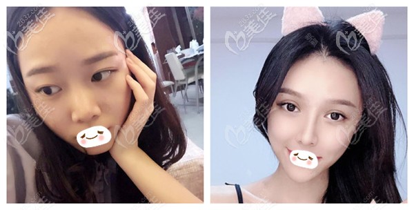 钱炳燊医生做软骨鼻综合案例