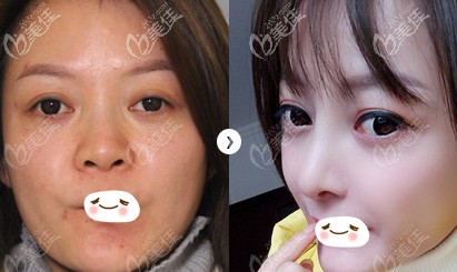 凌斌医生做半肋鼻综合案例