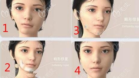 3d打印人工骨修复下颌角手术示意图