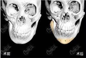 3d打印人工骨修复下颌角术前术后ct片对比