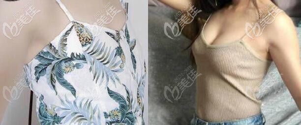 曼托水滴250cc假体隆胸一年效果图片 曼托水滴250cc假体隆胸一年效果图片