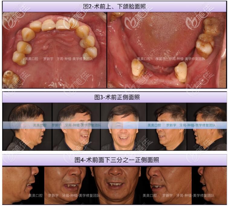 牙齿松动脱落术前样子 牙齿松动脱落术前样子
