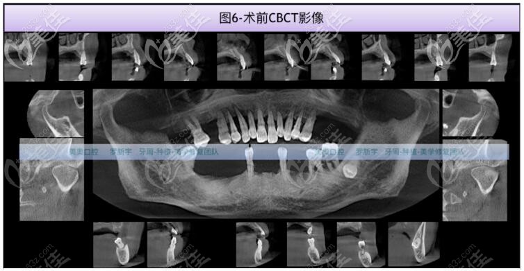 CT拍片检查牙齿情况 CT拍片检查牙齿情况