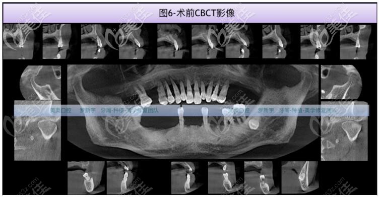CT拍片检查牙齿情况