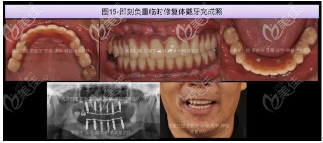做过烤瓷牙的65岁大爷牙齿松动脱落，在常州美奥重新做了NOBEL诺贝尔全口即刻种植牙