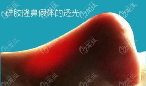 用自体筋膜可防止假体透光