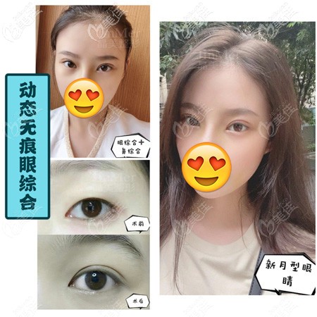 双眼皮改型到铜陵晶美做的效果