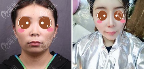 叶丽萍博士海鸥线隆鼻案例