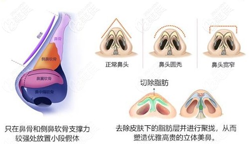 鼻综合手术方法