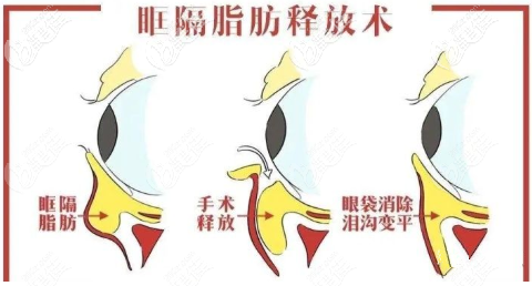 眶隔脂肪释放术