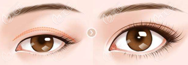 章沈云双眼皮特点 章沈云双眼皮特点