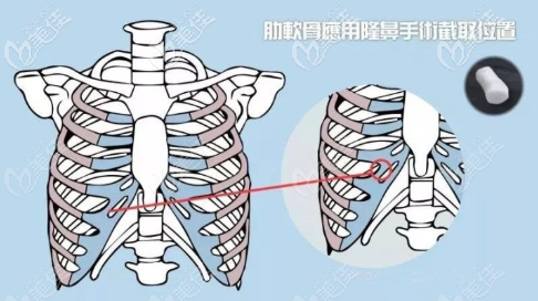 隆鼻全肋还是半肋好 隆鼻全肋还是半肋好