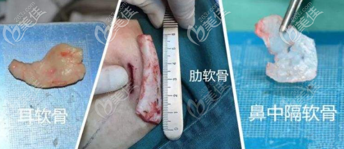 肋软骨和耳软骨哪个好 肋软骨和耳软骨哪个好