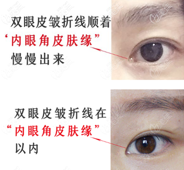 开扇形扇形双眼皮哪个好看 开扇形扇形双眼皮哪个好看
