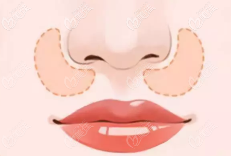 鼻基底凹陷示意图