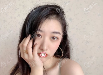 做完双眼皮后一个月 做完双眼皮后一个月