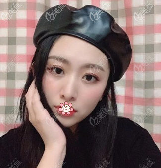 这回在重庆真熙美熙割的6mm全切双眼皮宽度正合适