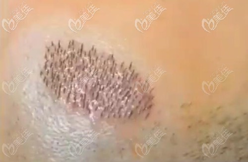 发际线种植200毛囊单位 发际线种植200毛囊单位